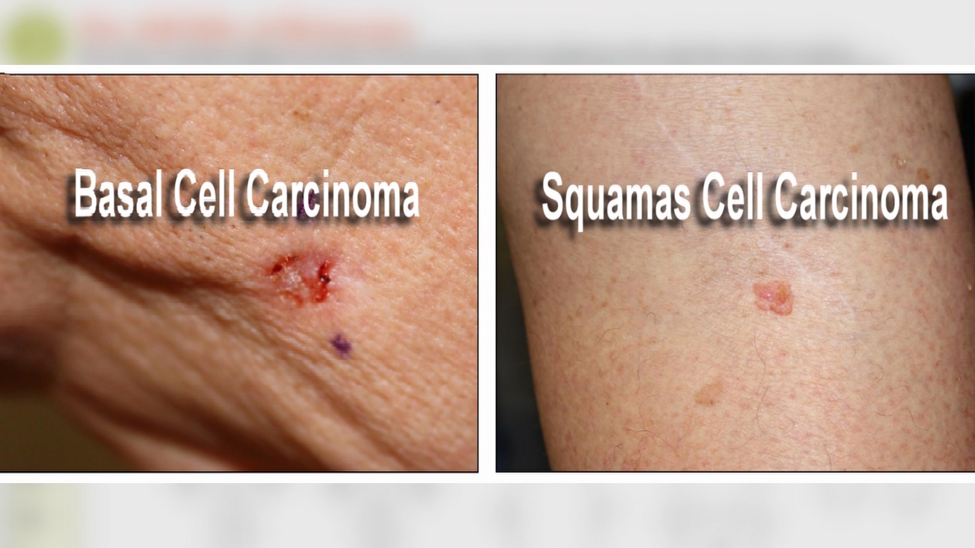 Do You Know All Of The Different Types Of Skin Cancers And Precancers ...